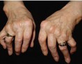 /album/fotogaleria/arthritis-jpg/